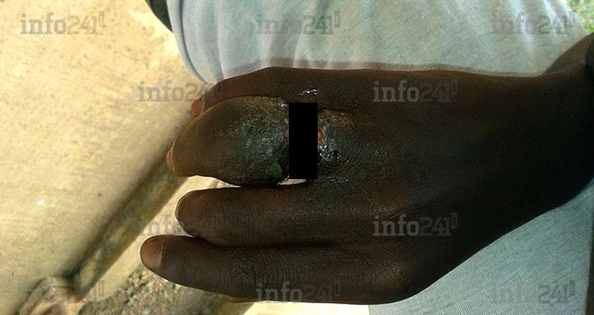 Le doigt du jeune homme à la bague magique-dévoreuse, finalement amputé